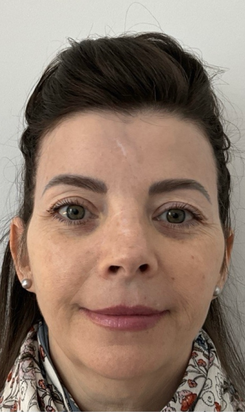 After treatment