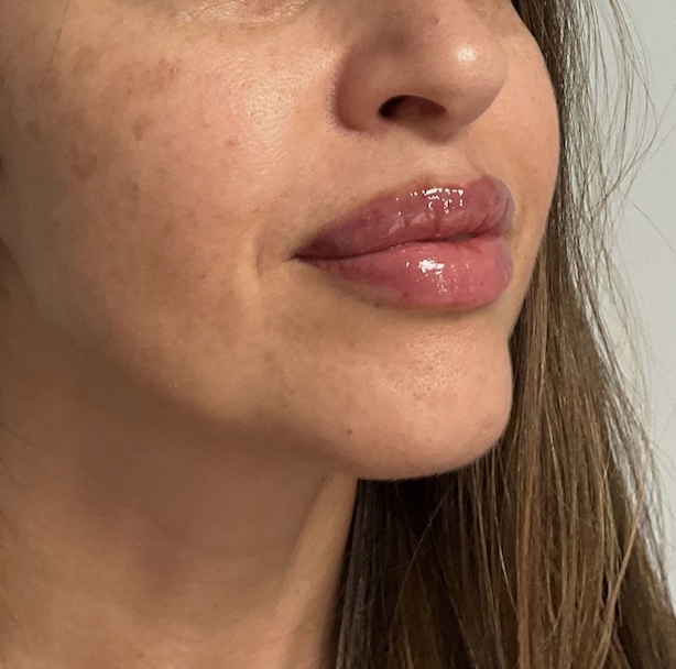 After treatment