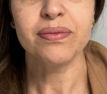Before treatment