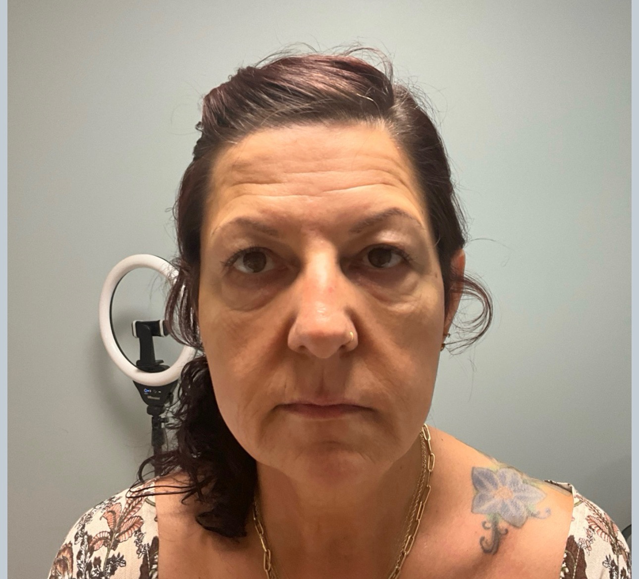 Before treatment
