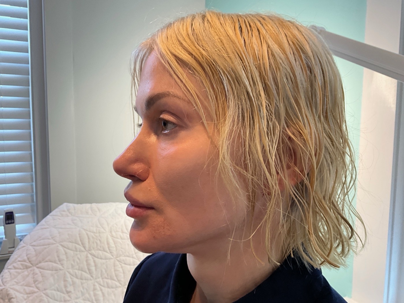 Before treatment
