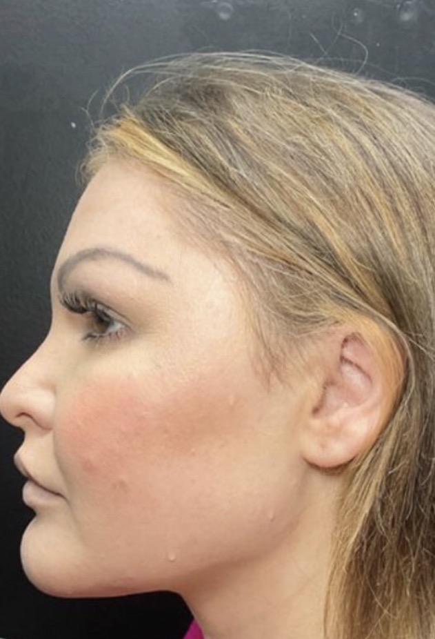After treatment