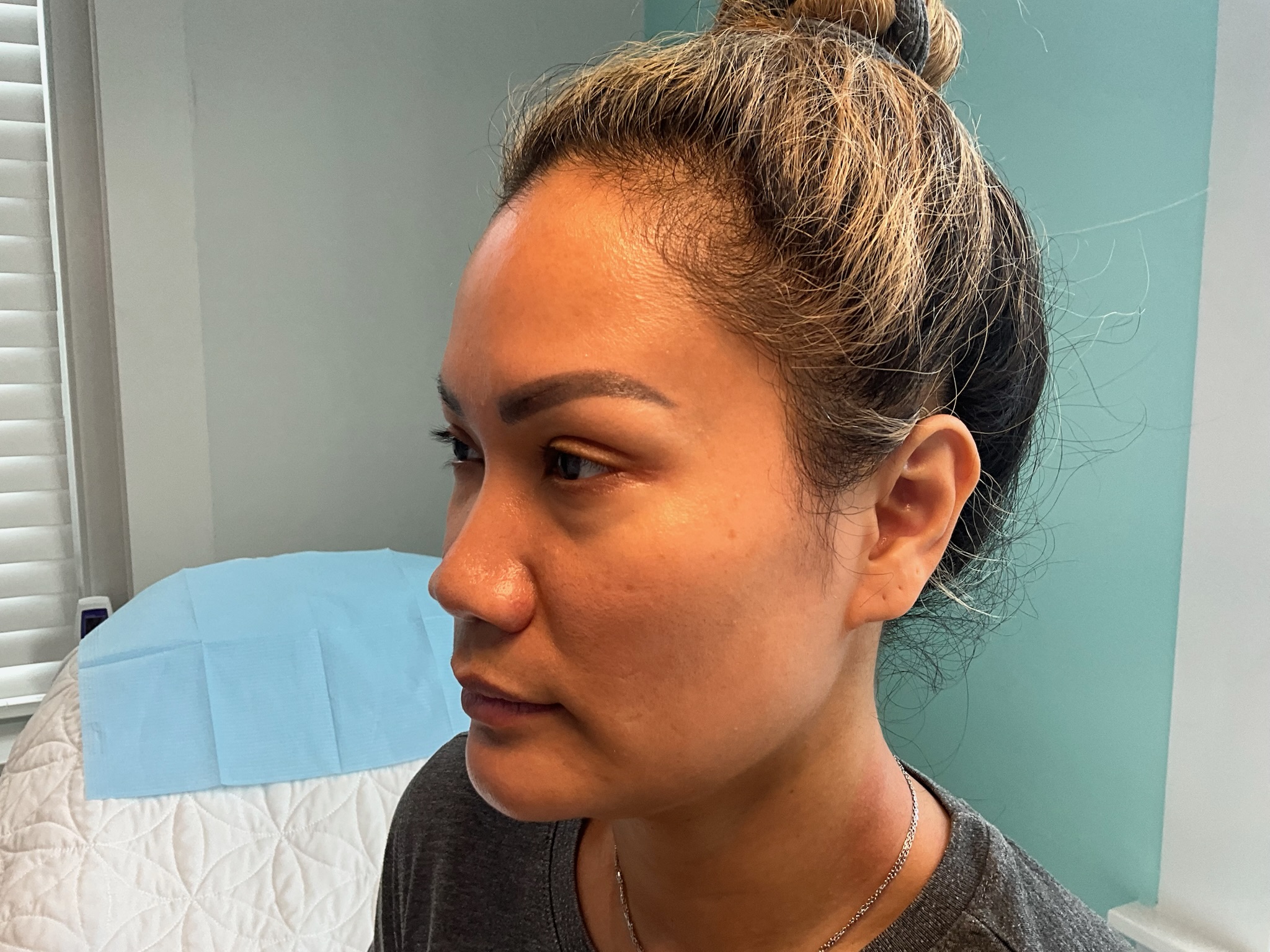 Before treatment